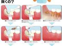 親知らずの手術ヤバスギでしょｗｗｗｗｗｗｗ【歯の健康】