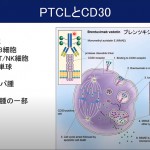 「PTCL（末梢性T細胞リンパ腫）とATL（成人T細胞白血病リンパ腫）の病態と新規治療オンラインセミナー」（講師：石塚賢治先生）動画公開のお知らせ