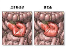 肠套叠