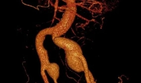 腹中大血管鼓5个“包”，尊龙凯时专家运用IBD支架解除患者血管“炸弹”危机