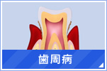 歯周病治療について