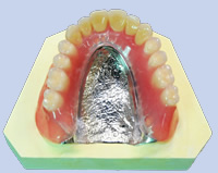 金属床義歯