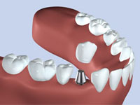 インプラント治療について