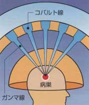 図1.ガンマーナイフ