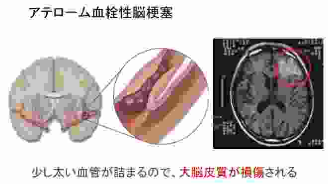 脳梗塞の分類を知っているあなたの次の一歩！