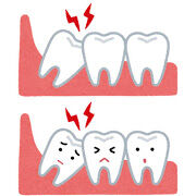 親知らず抜歯後そんなに痛くない
